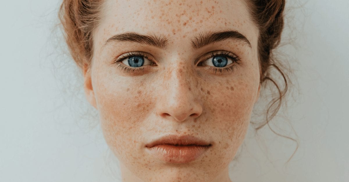 5-facts-about-freckles-you-didn’t-know-min.jpg